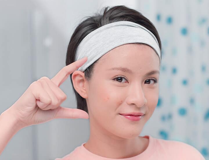 Acne Scarring ( Home Malay ) Acne Scarring ( Home Malay )
